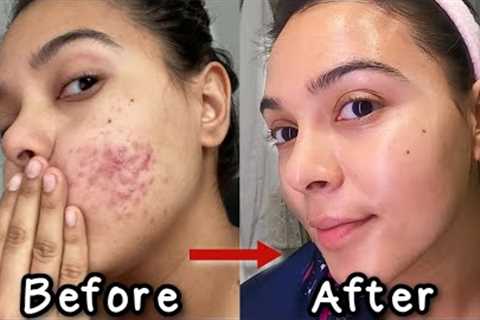 How I Got Rid of My Acne *3 products that changed my life* | NataliesOutlet