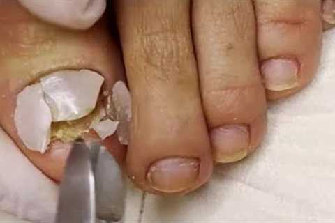 Fungal Nail with Dried Abscess 🦶 Ingrown Nail Treatment 🦶 Thick Fungal Toenail