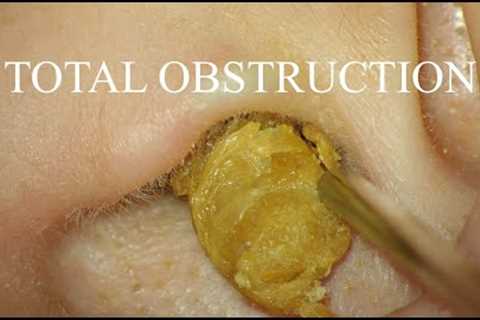 TOTAL OBSTRUCTION : EAR WAX REMOVAL : 4K/HD