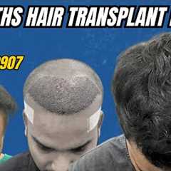 Hair Transplant In Kolkata || Best Result & Cost of Hair Transplant in Kolkata || 5 Months..