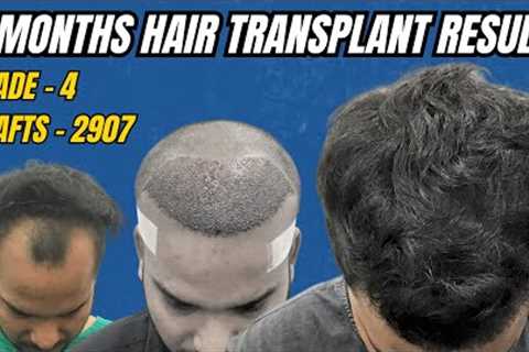 Hair Transplant In Kolkata || Best Result & Cost of Hair Transplant in Kolkata || 5 Months..