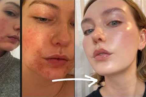 From rosacea + acne to glass skin — this skincare works